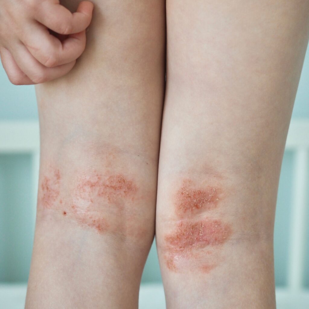 Photo of atopic dermatitis close up on a person's legs