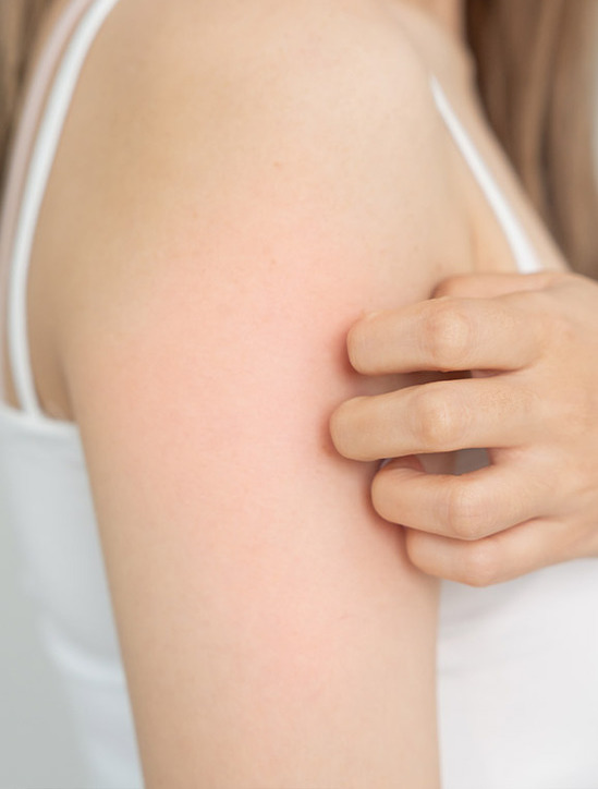 photo of a hives rash on a girl