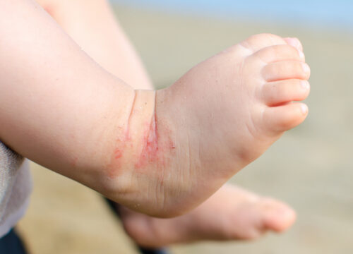Photo of eczema on a baby's foot