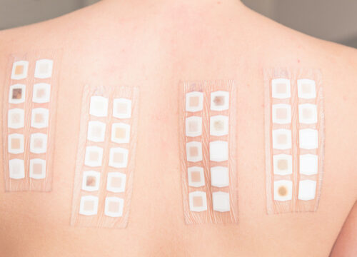 Photo of patch testing on a patient's back