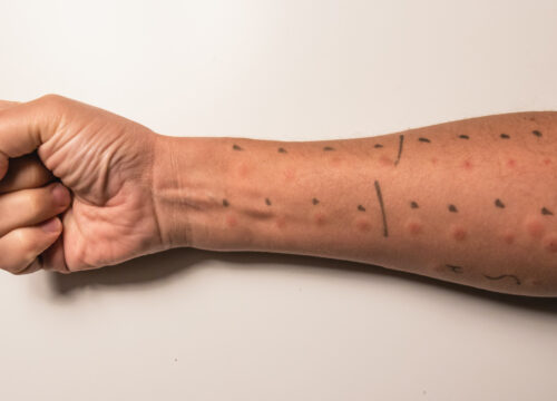 Photo of a man's arm during a Skin Prick Test