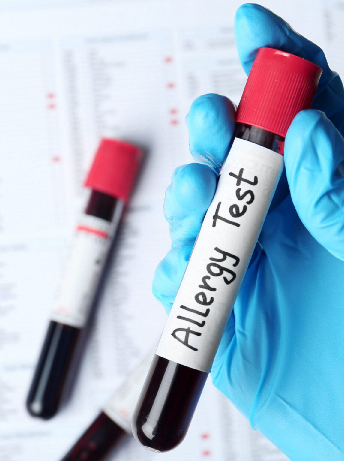 Blood Allergy Testing Laguna Allergy Medical Boutique